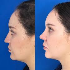 El botox siempre es nuestro...