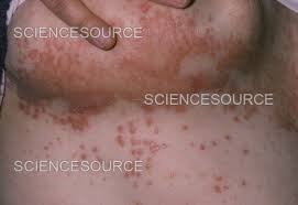 Image result for heat rash under breasts