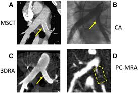Top msct abbreviation meanings updated february 2021. Comparison Of Pulmonary Artery Dimensions In Swine Obtained From Catheter Angiography Multi Slice Computed Tomography 3d Rotational Angiography And Phase Contrast Magnetic Resonance Angiography Springerlink