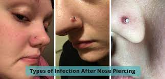 4 Things To Treat Infected Nose Piercing Bump Without Closing It Piercing Bump Nose Piercing Nose Piercing Bump