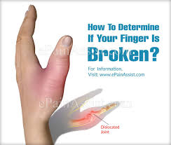 This can happen during daily activities but is more. How To Determine If Your Finger Is Broken Ways To Manage A Broken Finger