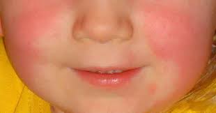 Scarlet Fever Is Back And Every Parent Needs To Watch Out For These Warning Signs Fever Symptoms Scarlet Fever Symptoms Fever Rash