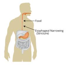 Food stuck in throat anatomy. Dysphagia Or Airway Blockage What Is The Difference Treatment