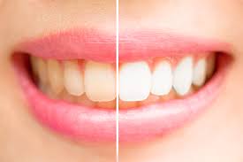 Teeth whitening is a common request for those who have just had their braces removed. The White Diet Foods You Can And Cannot Eat After Teeth Whitening