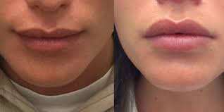 Lip flip, botox lips, jueveau lip flip, newtox lip flip, botox lip pop. Lip Flip How It Works What It Costs And What To Expect