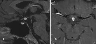 Single Center Study Of 53 Consecutive Patients With Pituitary Stalk Lesions Springerlink
