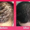 Hair loss treatment in hyderabad. Https Encrypted Tbn0 Gstatic Com Images Q Tbn And9gcqauvlahgzl L2zm1zkbq5ovzw3ltgunulw N9l Sbtfqk5c3ou Usqp Cau