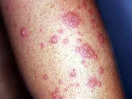 It is an early indication in most cases and occurs within two to three weeks after you have contracted the virus. Herpes Simplex Dermnet Nz