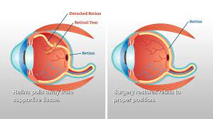 The most common surgical procedures for reattaching a retina are scleral buckling, pneumatic retinopexy and vitrectomy. Retinal Detachment Treatment And All About It Healing Clinic Turkey