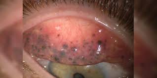 Conditions like dry eye or eyelid inflammation (blepharitis) can mimic the sensation of a foreign object. Years Of Embedded Mascara Found Under Woman S Eyelid American Academy Of Ophthalmology