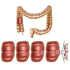 Image result for Colorectal Cancer