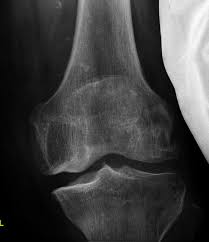 Fall Knie Mediale Arthrose Im Kniegelenk