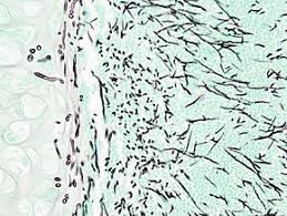 Invasive aspergilosis, chronic necrotizing aspergilosis, aspergilloma and allergic. Aspergillosis Zxc Wiki