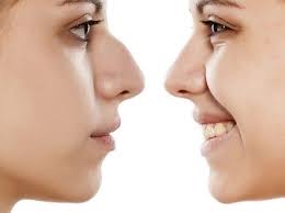 The price of a nose job range from $3000 and up, there is no public information on how much michael paid for his. Nose Job Surgery Rhinoplasty Cape Town
