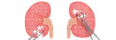 Best Kidney Transplant Cost Worldwide Bookimed