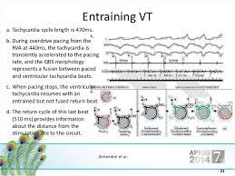 If fusion during atrial overdrive pacing in svt is present. How To Perform And Interpret Entrainment Pacing Basics