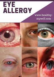 Eye Allergy Eye Allergy Symptoms Home Remidies Details 2019 Eye Allergy Symptoms Allergy Eyes Eye Allergy