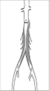 Two Year Primary Patency Rates After Aortoiliac Occlusive Disease Endovascular Treatment Iranian Journal Of Radiology Full Text