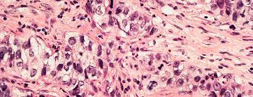 Maybe you would like to learn more about one of these? Biopsy For Breast Cancer Diagnosis Stereotactic Core Biopsy Ucsf Health