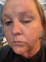 What could be causing my white leghorn hen's large comb and walking in  circles behavior?