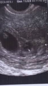 Ajudaaaa Gravidez De Gemeos Um Nao Se Ouve Os Batimentos Abril De 2018 Babycenter