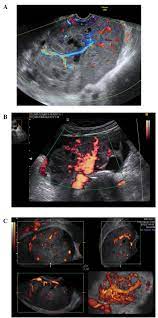 An ovarian cancer ultrasound is one of several diagnostic tests that your doctor will use to determine if ovarian cancer is present. The Characteristic Ultrasound Features Of Specific Types Of Ovarian Pathology Review