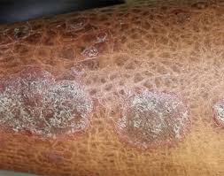 Image result for Eczema nummulare