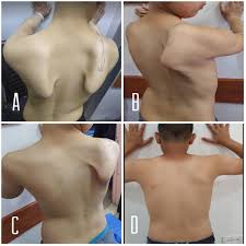 Image result for Winged Scapula