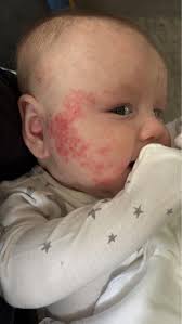 Any advice for eczema please, my son had it when he was newborn. we used a  homeopath as it was after his V A X that it developed. He never had anymore