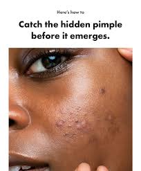 Try a pimple patch, which is a flat,. Mighty Patch Can You Spot The Blind Pimple Milled