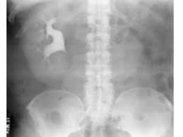 Renal Agenesis Is The Absence Of A Developed Kidney It Can Happen Unilaterally Or Bilaterally The Latter Being A Fatal Renal Chronic Kidney Disease Medical