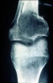 Knowing the signs of cancer in cats and things you can do to watch for cancer can literally save your cat's life. Bone Cancer In Dogs And Cats