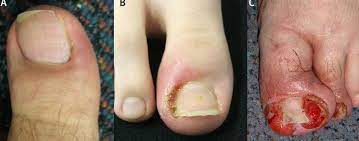 Instead, prop it up gently by putting a small amount of cotton in between the nail and the nail bed. Ingrown Toenail Treatment Custom Foot Clinic Orthotic Centre