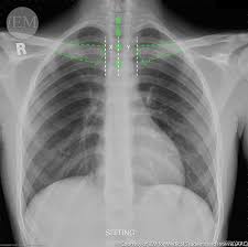 How To Read Chest X Rays International Emergency Medicine Education Project