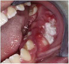 Image result for spinocellular carcinoma of the oral cavity