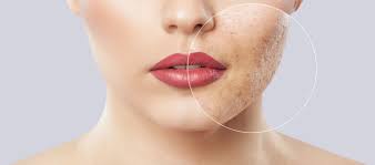 Beim genauen betrachten sieht man sowas wie einen kleinen 'krater' oben drauf. Wie Deckt Man Eitrige Pickel Ab Unreinheiten Make Up Tipps Make Up Lombagine