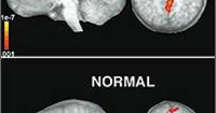 Asperger sendromu otizm ile karıştırılan gelişimsel bir bozukluktur. Otizm Ve Asperger Sendromu