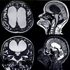 Image result for Hydrocephalus