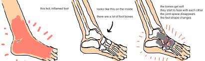 Also called charcot joint or neuropathic joint, charcot arthropathy is a progressive condition of the musculoskeletal system that is characterized by joint dislocations, pathologic fractures, and. Charcot Foot Bone Talks