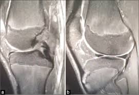 Image result for PCL Sulcus Test