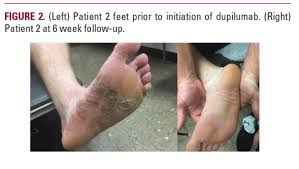 Image result for pompholyx soles of feet