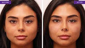 Quälen auch sie dunkle augenringe oder geschwollene tränensäcke? Augenringe Unterspritzen D Aesthetic Dr Sina Djalaei