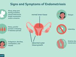Un gruppo per discutere, confrontarsi e parlare di endometriosi. 11 Natural Treatments For Endometriosis