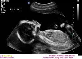 How Accurate Are Ultrasounds Experts Weigh In