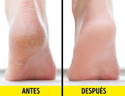 Los #Pies agrietados surgen cuando la piel está muy seca y, por esto, se  agrieta con el peso del cuerpo y de la presión sobre los pies por las  actividades a diario