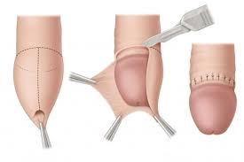 Image result for paraphimosis