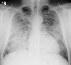 The american lung association (ala) says ards is a rapidly progressive disease that can occur in critically ill patients—most notably now, in those diagnosed with severe illness resulting from. Acute Respiratory Distress Syndrome Ards Physiopedia
