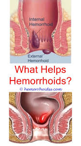 How Do You Fix Hemorrhoids Hemorrhoids Treatment Home Remedies For Hemorrhoids Bleeding Hemorrhoids