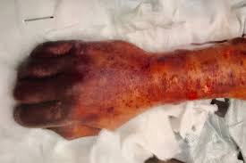 What should i do?know the risks. Man Dies After Being Licked By His Dog In Tragic And Rare Medical Case