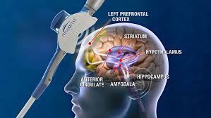 Maybe they only partially worked, or didn't work at all, so now you're considering transcranial magnetic stimulation, or tms. Tms Therapy Transcranial Magnetic Stimulation Diamond Lake Clinic Minneapolis
